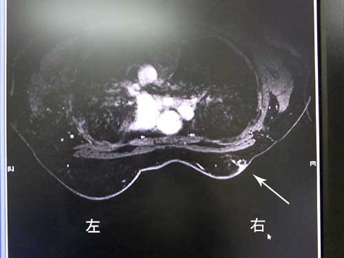 追加検査の結果はok 温存手術の傷跡近くの硬いものは経過観察していくことに 乳がんブログ 乳癌術後12年で温存乳房内局所再発