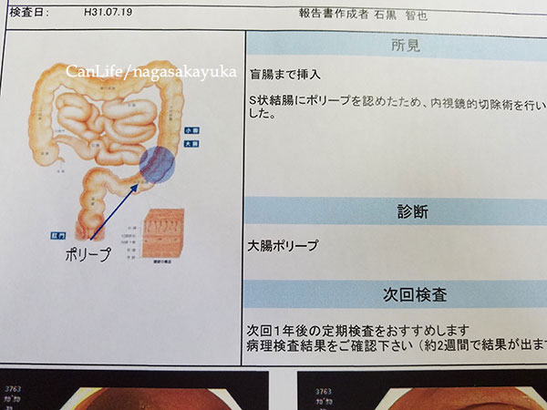 大腸にポリープがありました