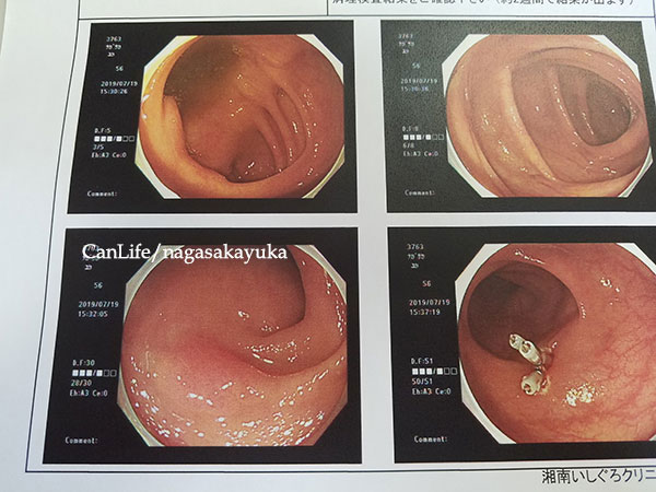大腸内の写真
